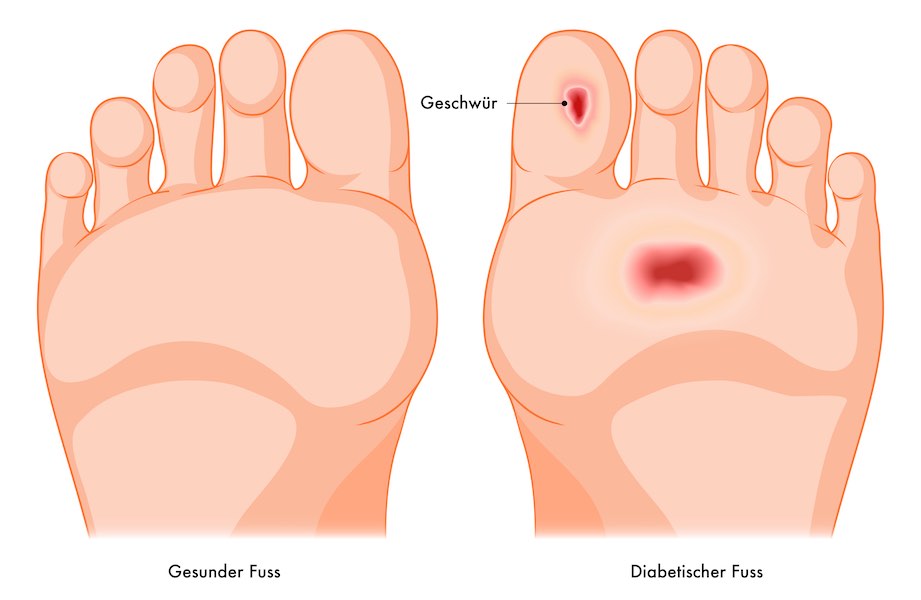 Erste Symptome von einem diabetischen Fuss. 